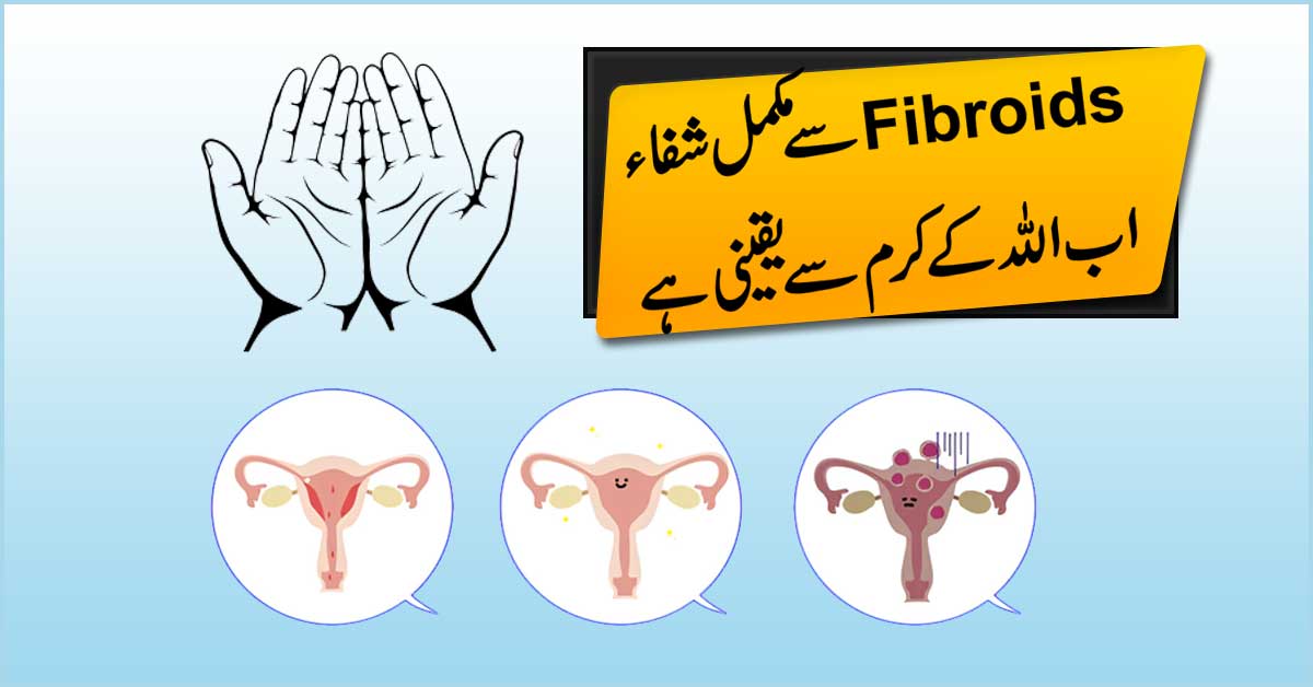 Fibroids Se Hamesha Ke Liye Nijat
